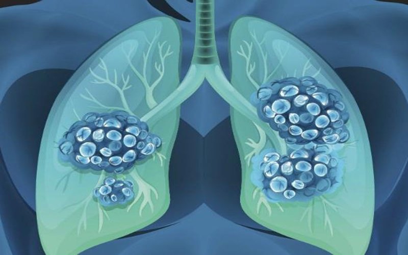 Acute Respiratory Distress Syndrome (ARDS)